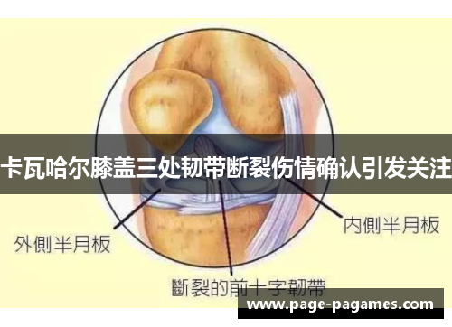 卡瓦哈尔膝盖三处韧带断裂伤情确认引发关注
